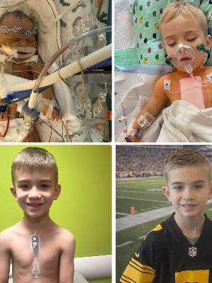 Luca is a 6-year-old boy whom is followed at the UPMC Children's Hospital of Pittsburgh for care of his complex congenital heart disease. Luca was diagnosed with RV dilation, bicuspid aortic valve, mitral stenosis and a hypoplastic aortic arch with coarctation of the aorta. He has undergone multiple surgical procedures since birth and will continue to require close monitoring with a comprehensive plan of care in the future.